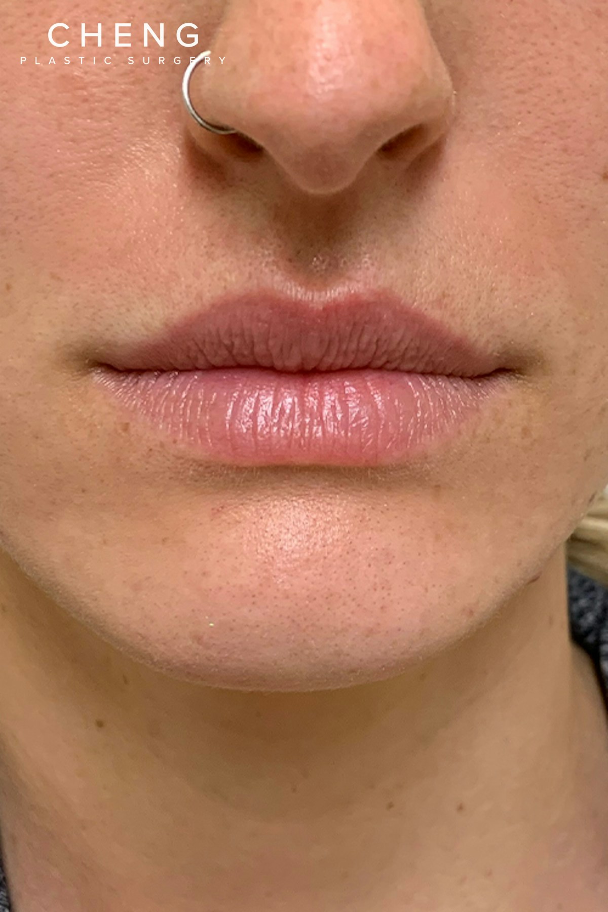 Hidden Patients Before & After Gallery - Patient 228114 - Image 1