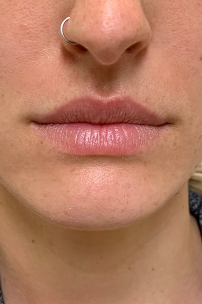 Hidden Patients Before & After Gallery - Patient 228114 - Image 1