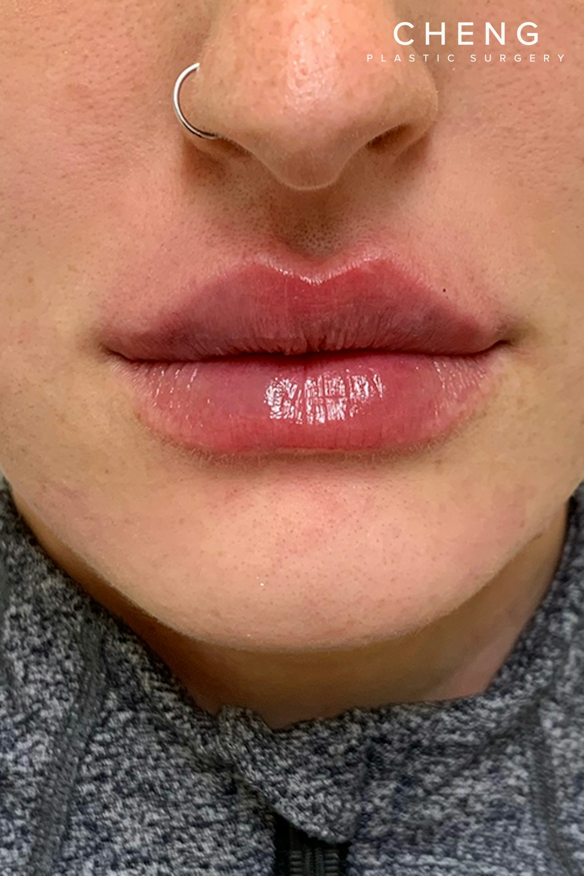 Hidden Patients Before & After Gallery - Patient 228114 - Image 2