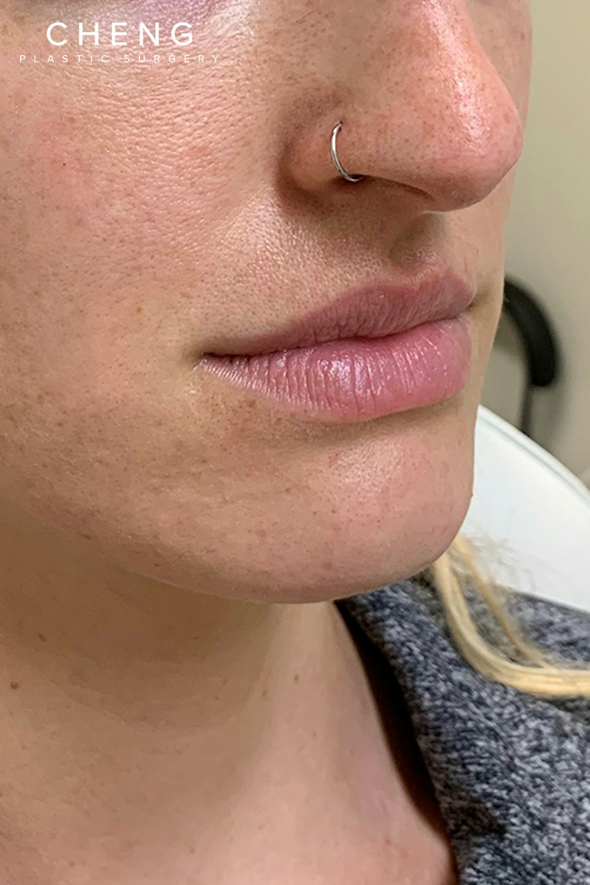 Hidden Patients Before & After Gallery - Patient 228114 - Image 3