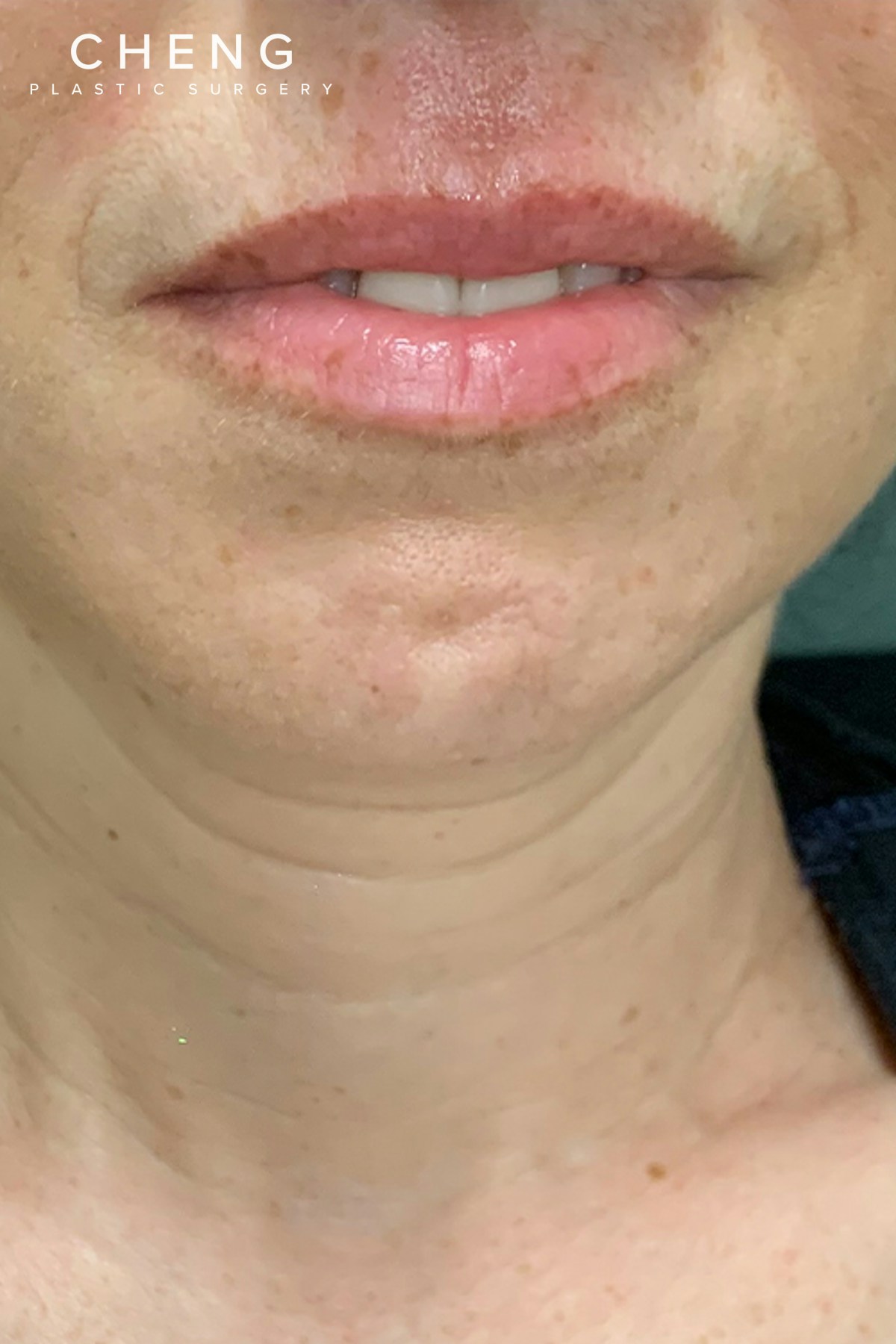 Hidden Patients Before & After Gallery - Patient 766680 - Image 1