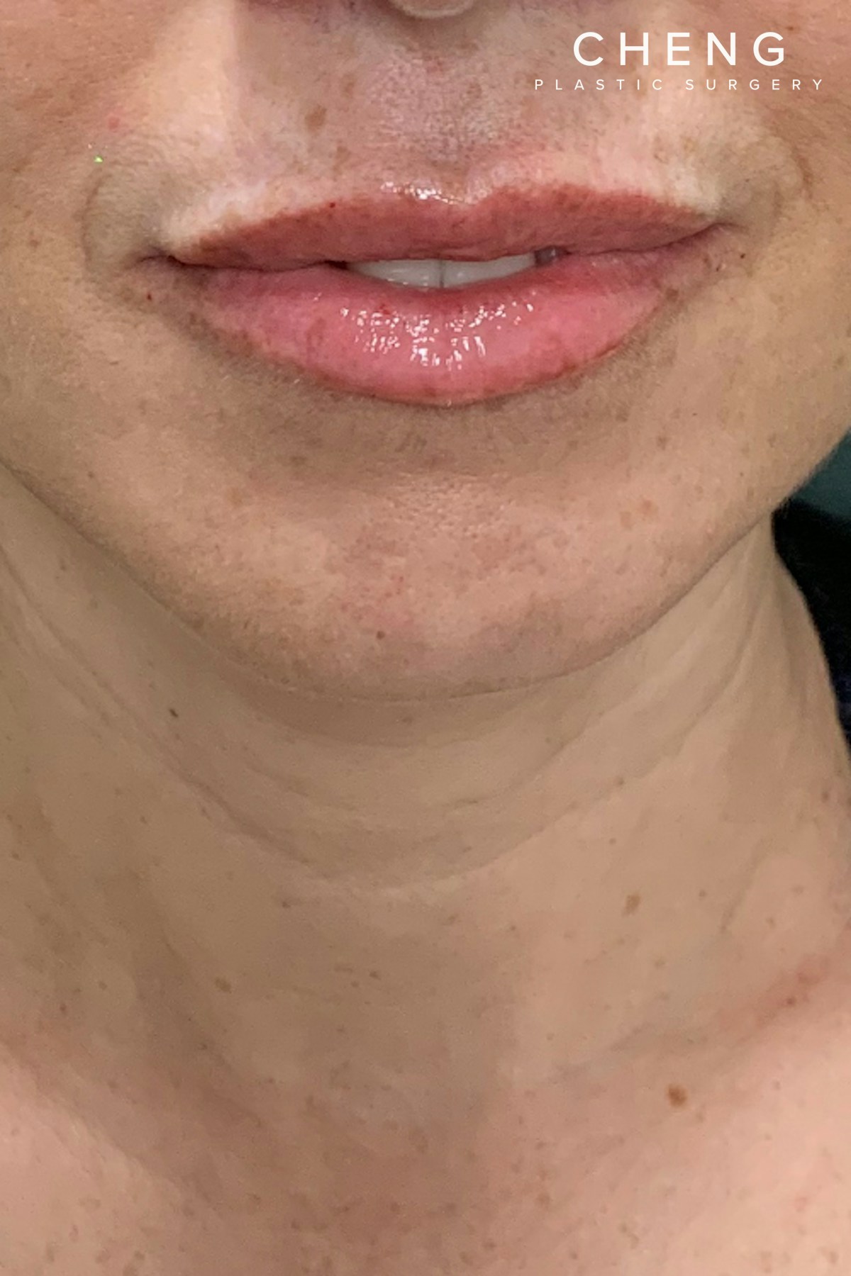 Hidden Patients Before & After Gallery - Patient 766680 - Image 2