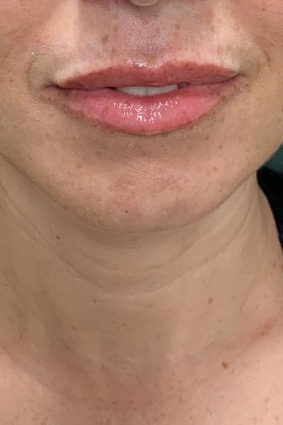 Hidden Patients Before & After Gallery - Patient 766680 - Image 2
