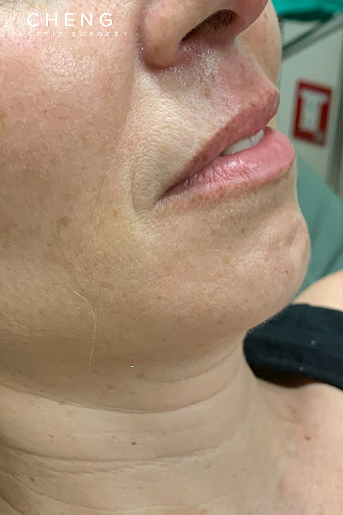 Hidden Patients Before & After Gallery - Patient 766680 - Image 3