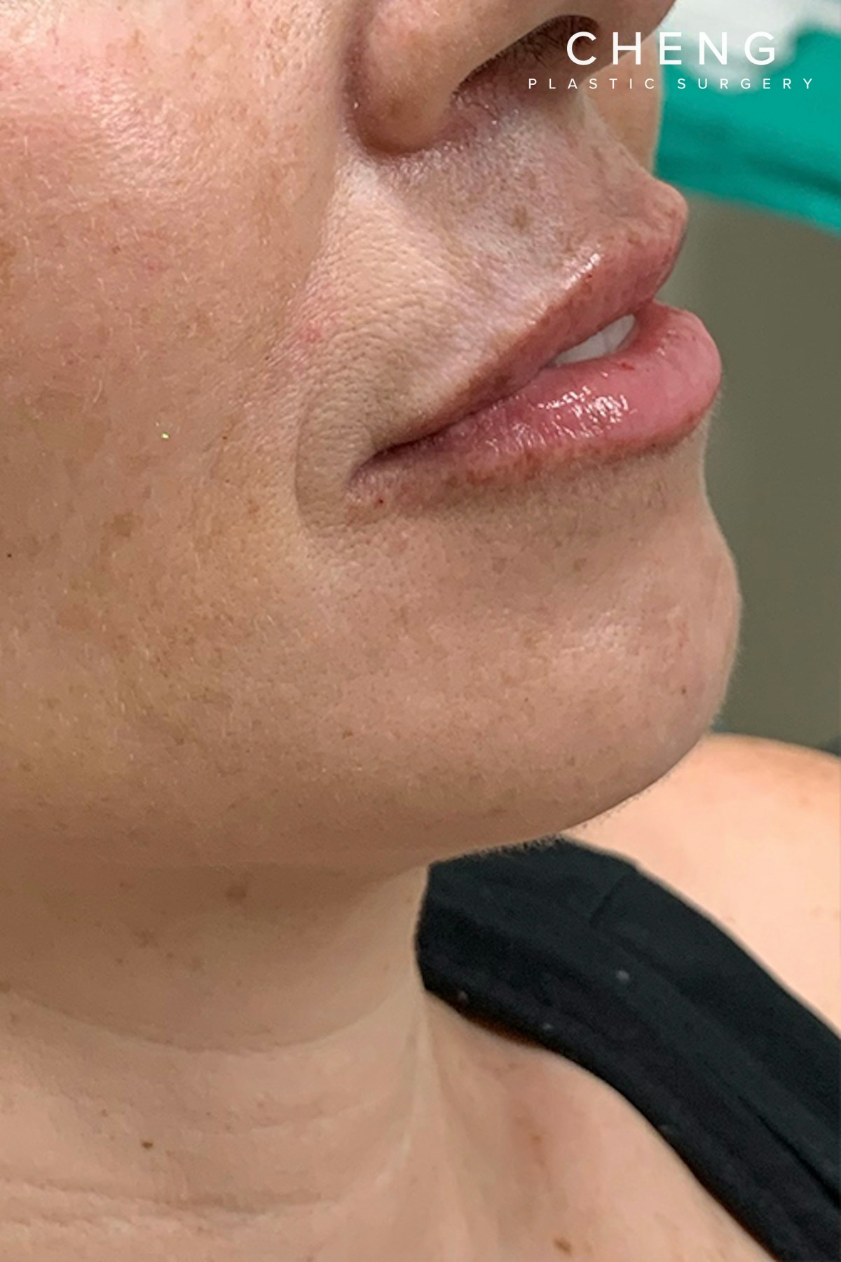 Hidden Patients Before & After Gallery - Patient 766680 - Image 4
