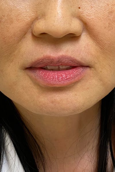Hidden Patients Before & After Gallery - Patient 709263 - Image 1