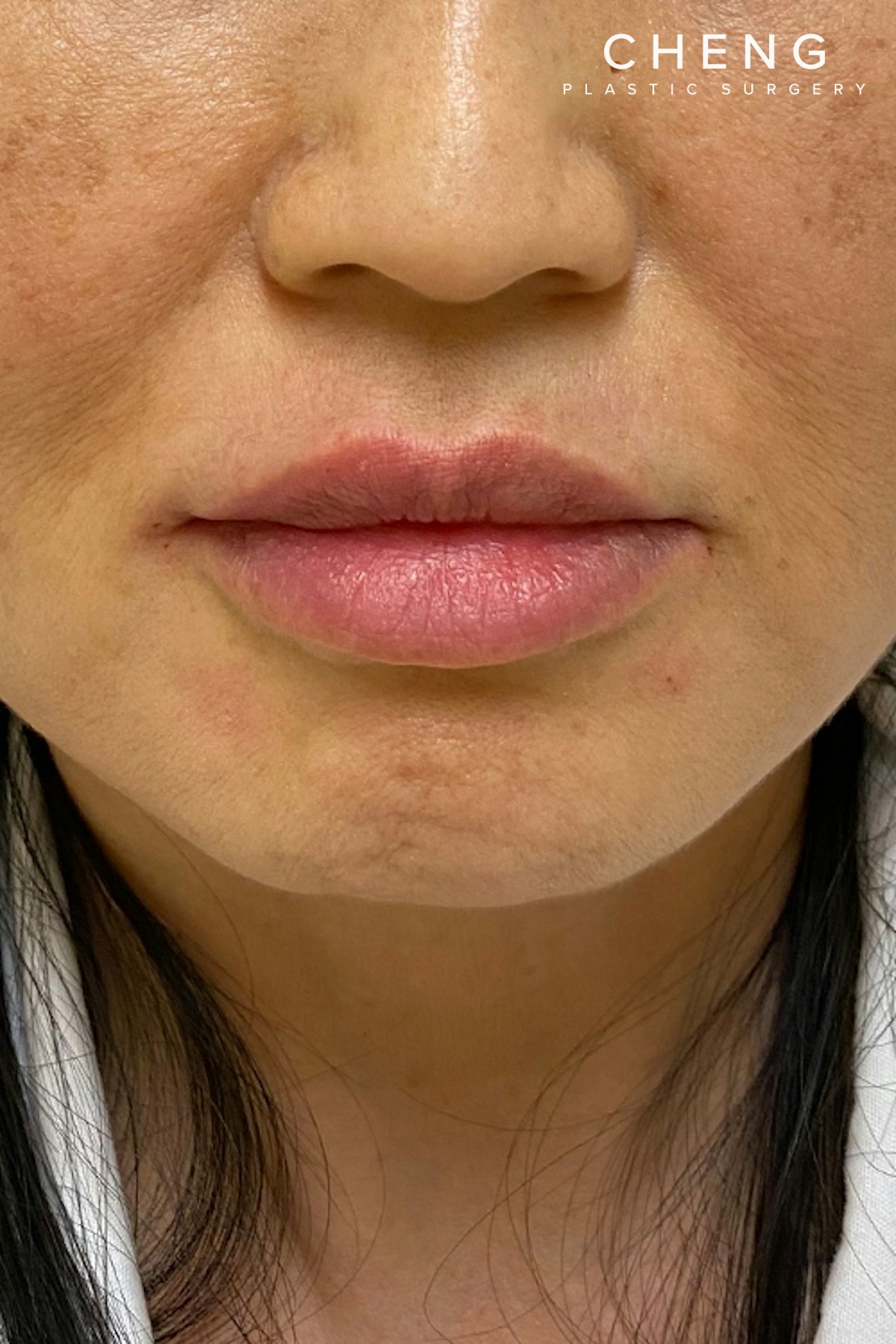 Hidden Patients Before & After Gallery - Patient 709263 - Image 2