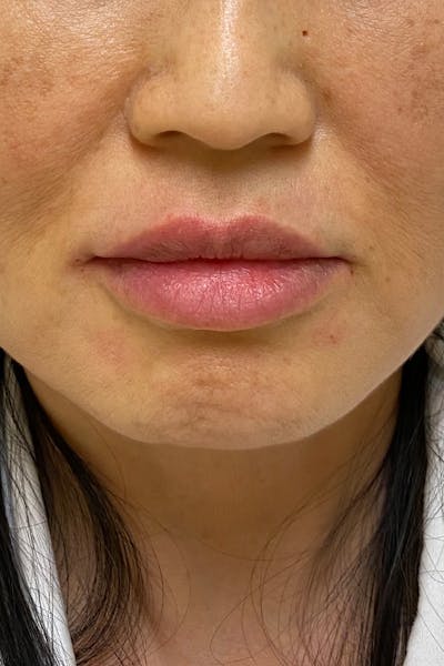 Hidden Patients Before & After Gallery - Patient 709263 - Image 2