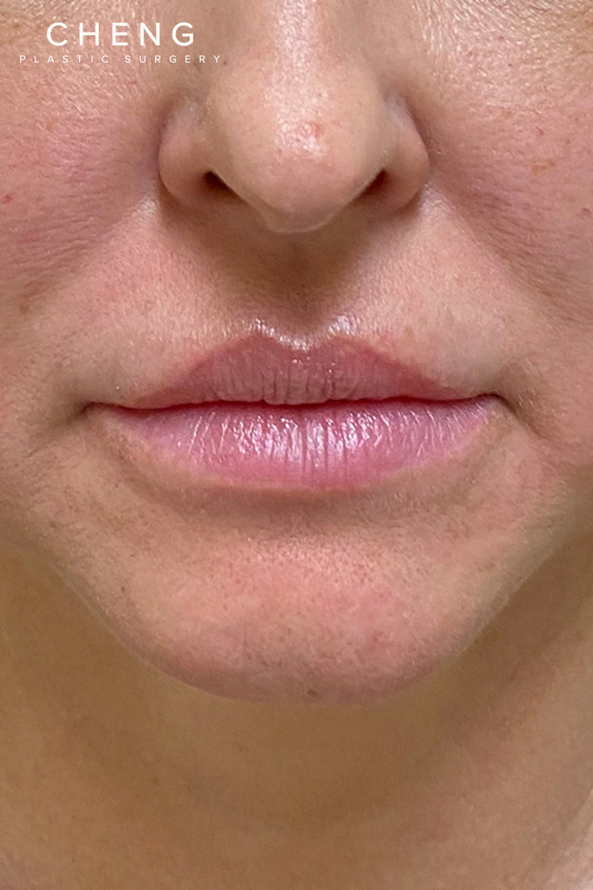 Hidden Patients Before & After Gallery - Patient 241685 - Image 1