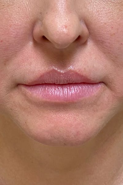 Hidden Patients Before & After Gallery - Patient 241685 - Image 1