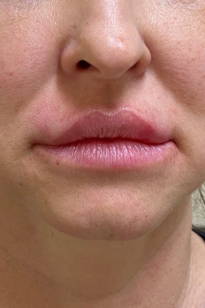Hidden Patients Before & After Gallery - Patient 241685 - Image 2