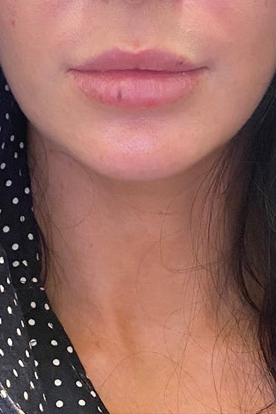 Dermal Fillers Before & After Gallery - Patient 358163 - Image 1