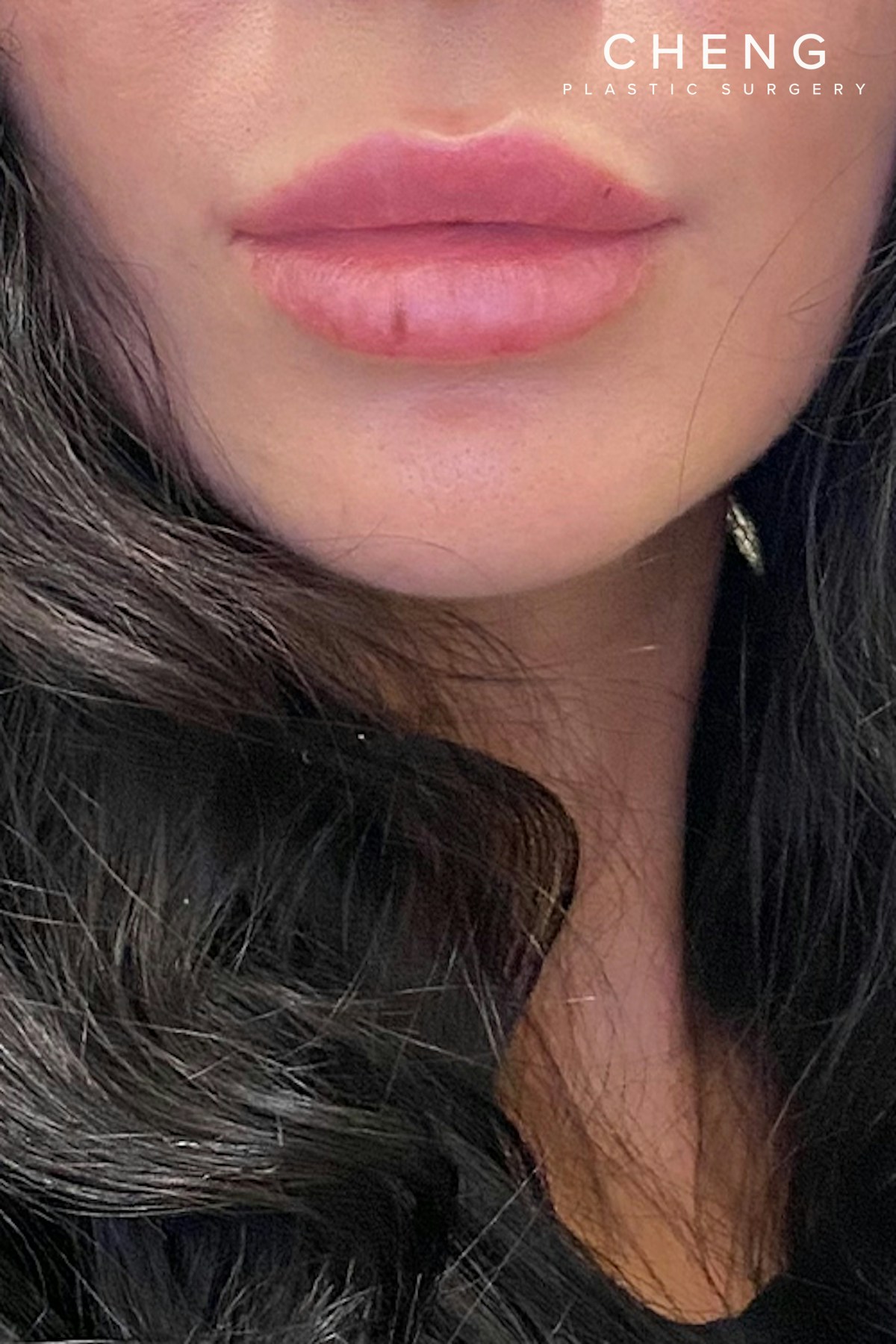 Dermal Fillers Before & After Gallery - Patient 358163 - Image 2