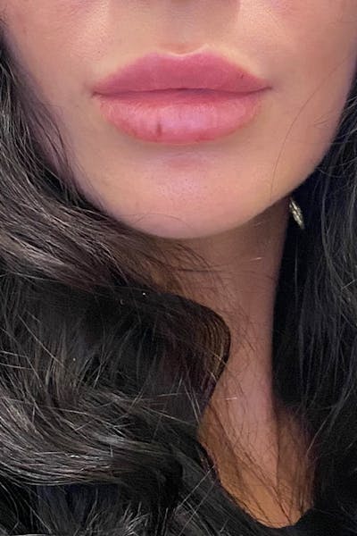 Dermal Fillers Before & After Gallery - Patient 358163 - Image 2