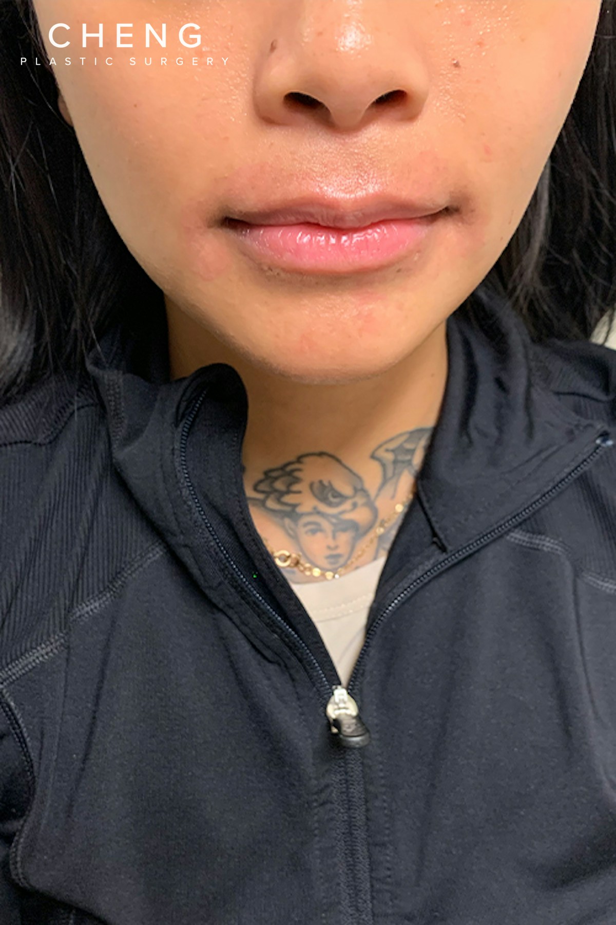 Dermal Fillers Before & After Gallery - Patient 399752 - Image 1