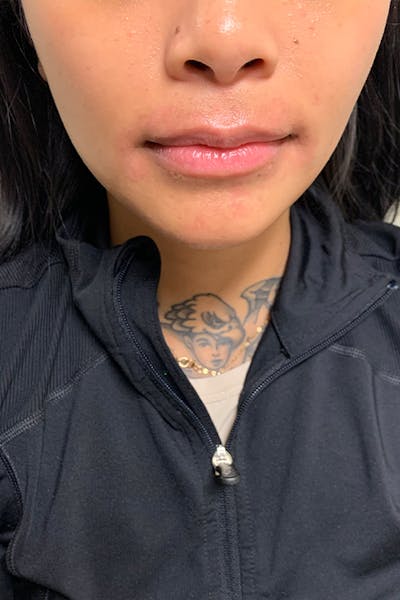 Dermal Fillers Before & After Gallery - Patient 399752 - Image 1
