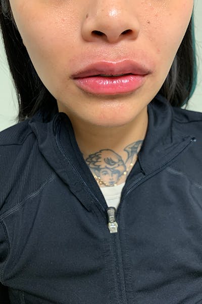 Dermal Fillers Before & After Gallery - Patient 399752 - Image 2