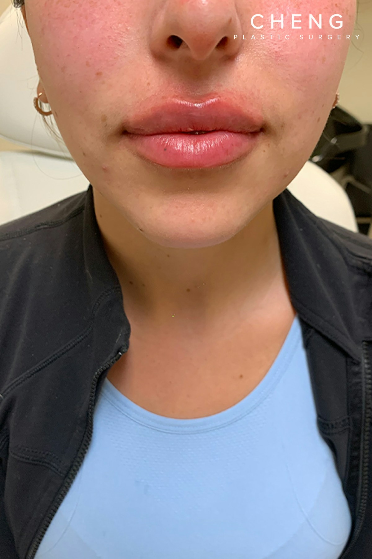 Hidden Patients Before & After Gallery - Patient 320250 - Image 2