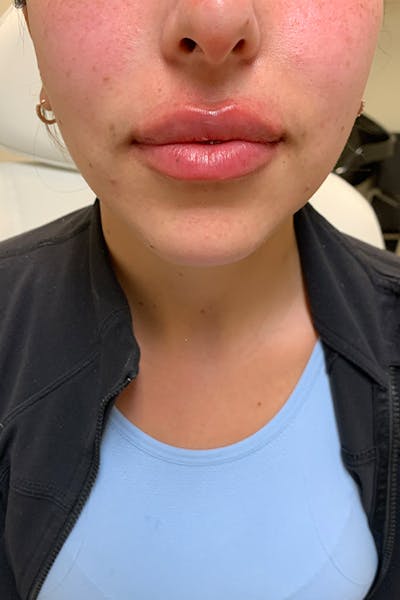 Hidden Patients Before & After Gallery - Patient 320250 - Image 2