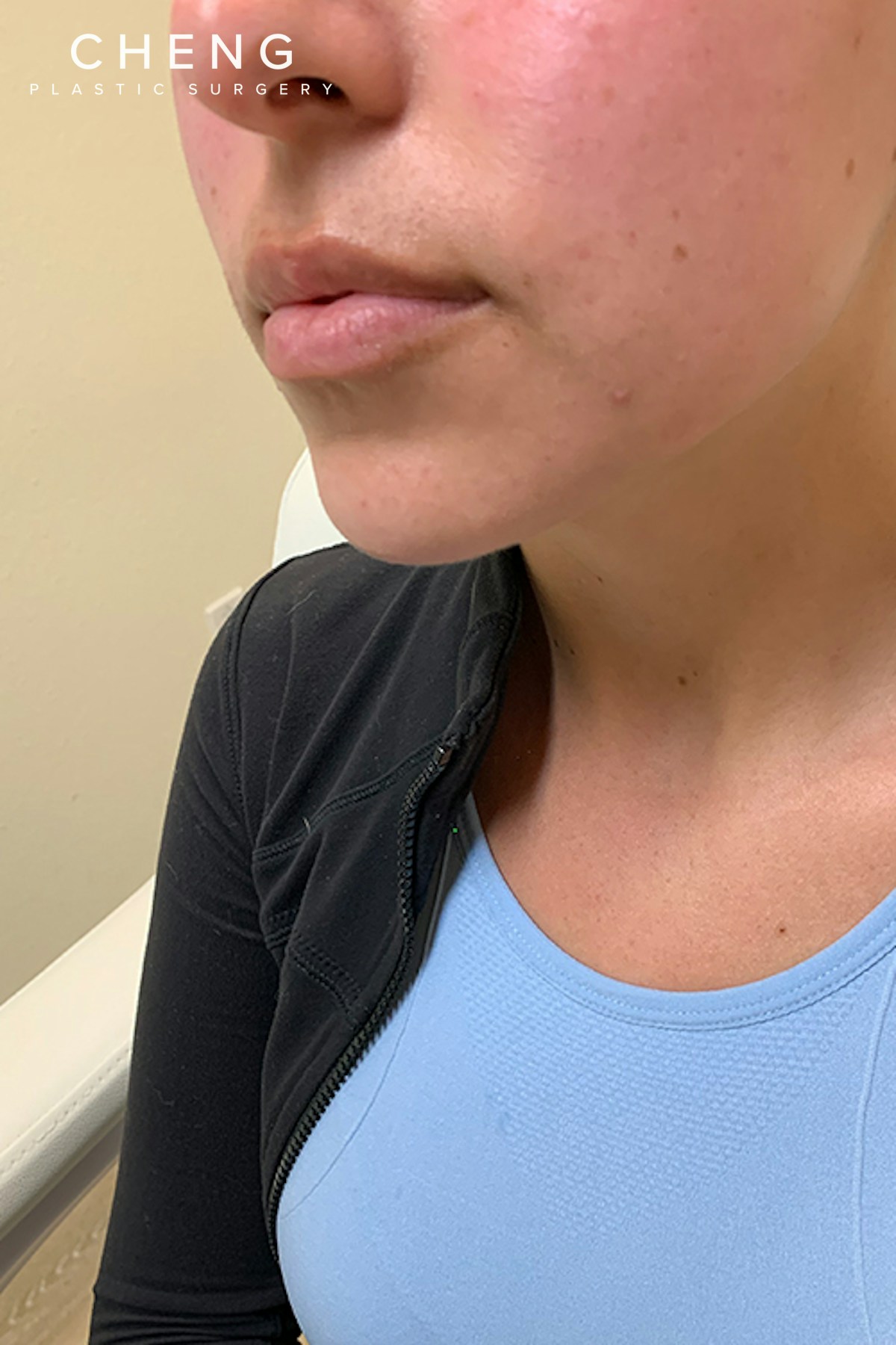 Hidden Patients Before & After Gallery - Patient 320250 - Image 3