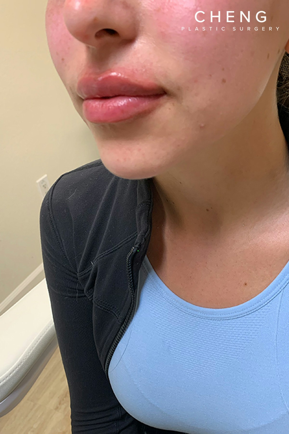 Hidden Patients Before & After Gallery - Patient 320250 - Image 4