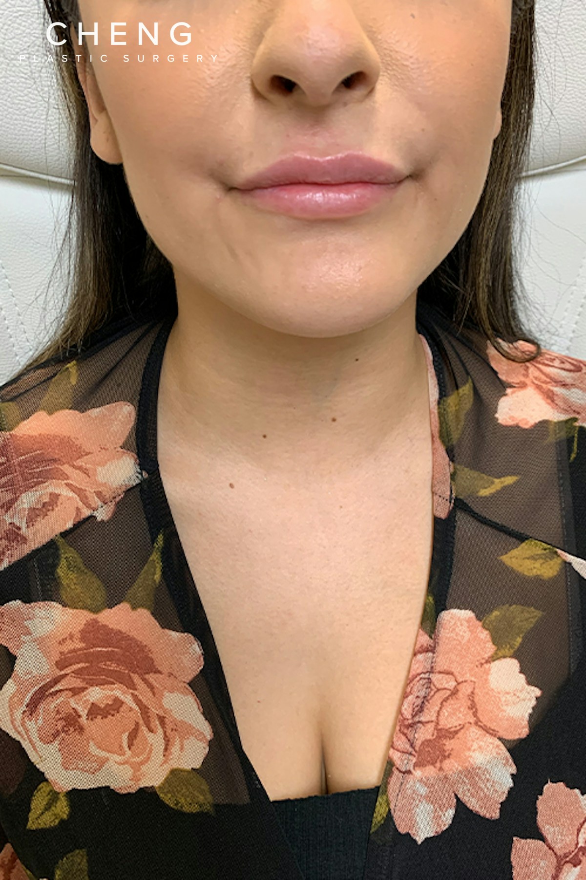 Hidden Patients Before & After Gallery - Patient 255475 - Image 1