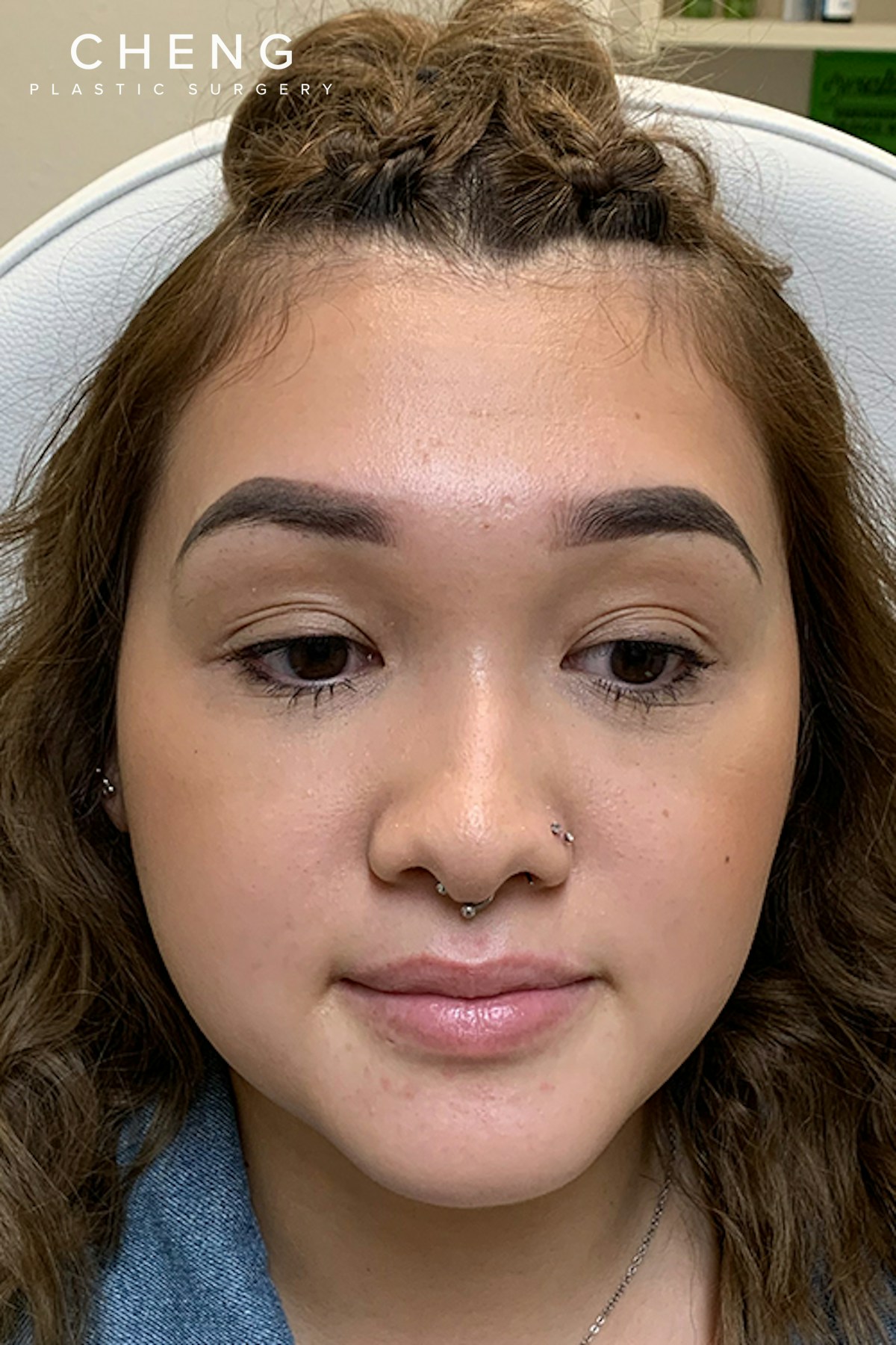 Hidden Patients Before & After Gallery - Patient 215125 - Image 3