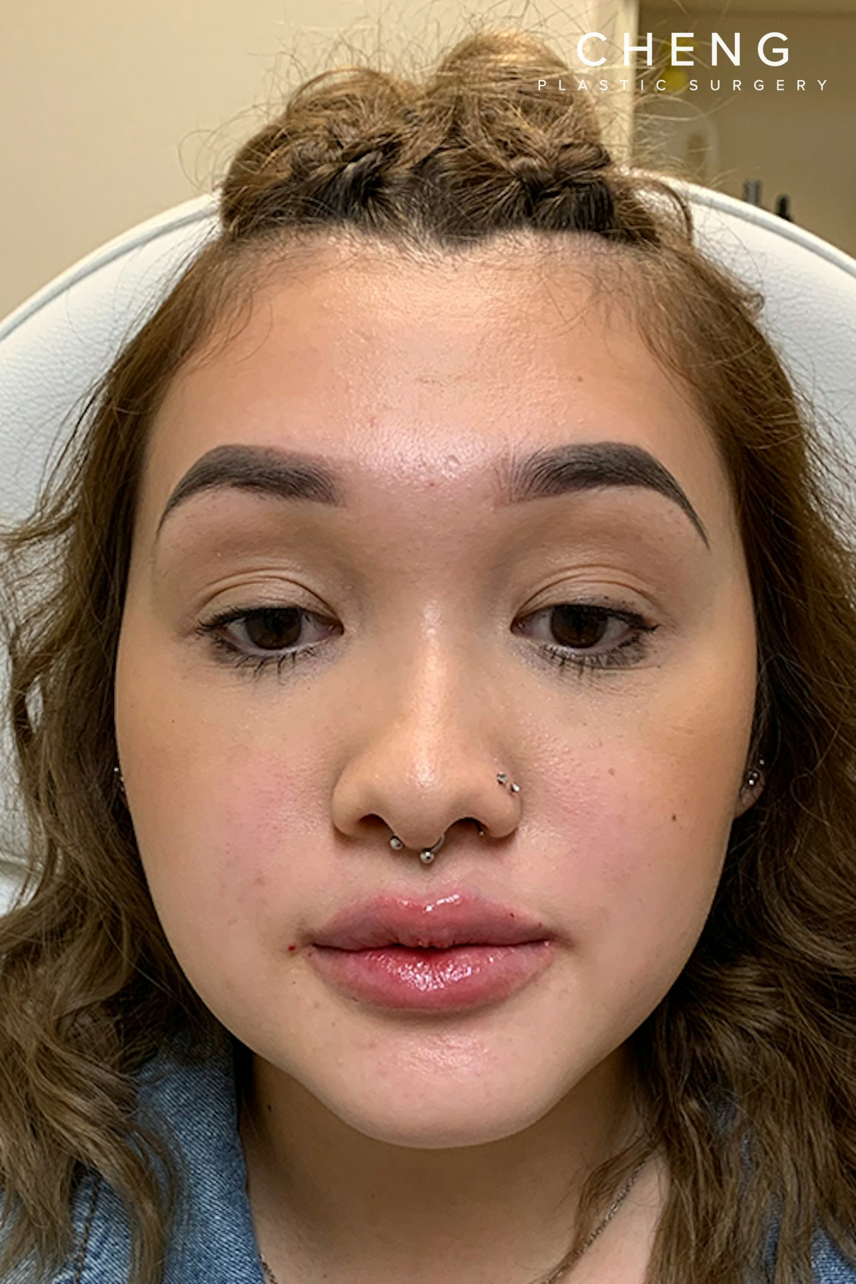 Hidden Patients Before & After Gallery - Patient 215125 - Image 4