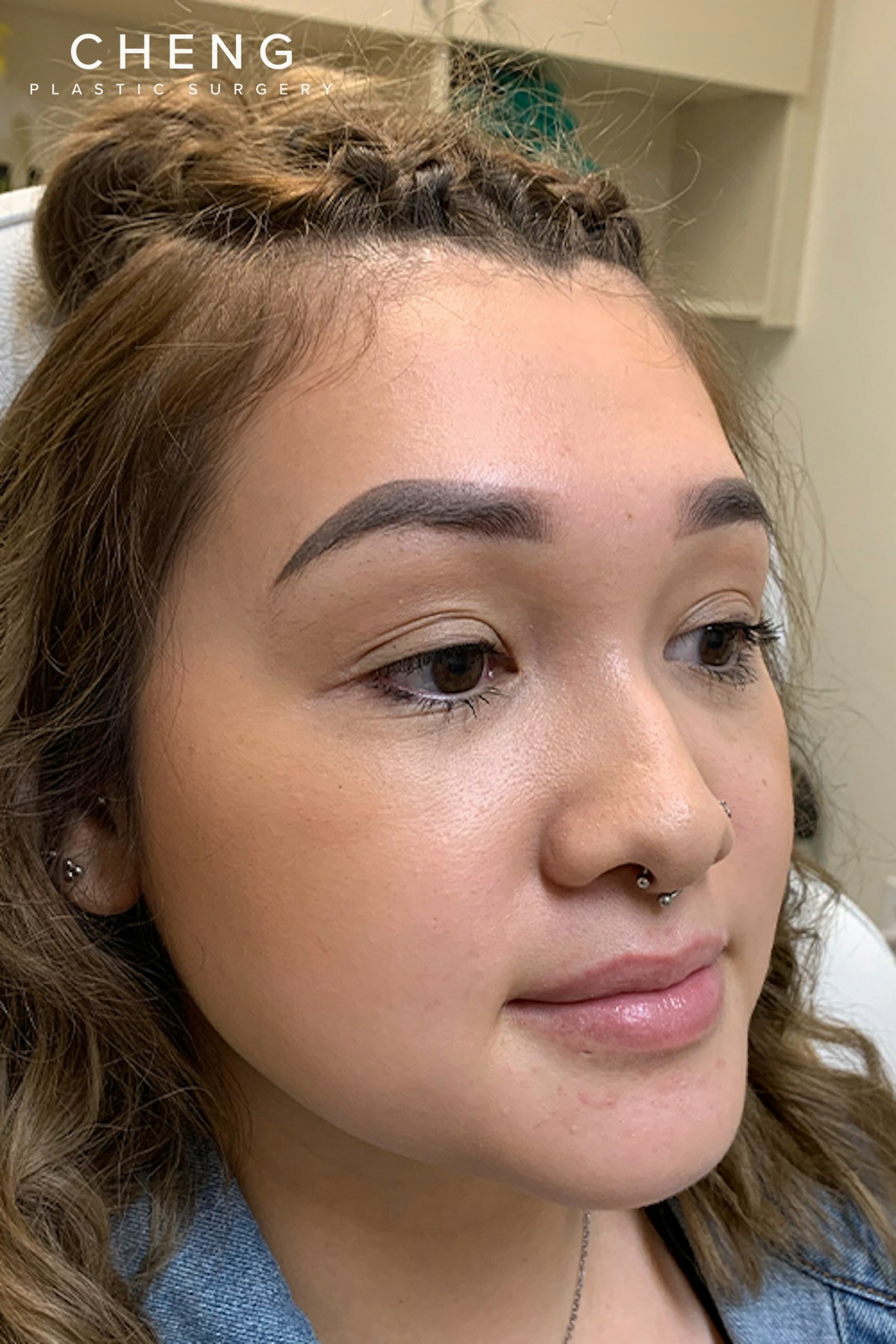Hidden Patients Before & After Gallery - Patient 215125 - Image 5