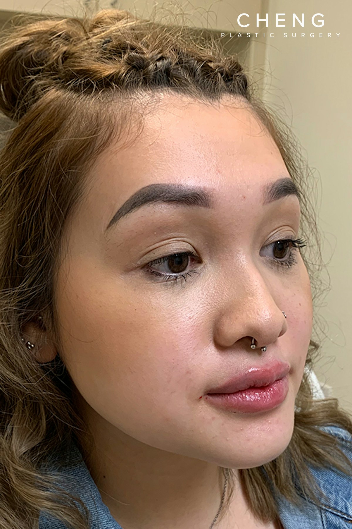 Hidden Patients Before & After Gallery - Patient 215125 - Image 6