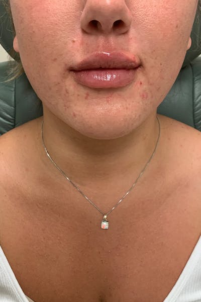 Hidden Patients Before & After Gallery - Patient 151109 - Image 2