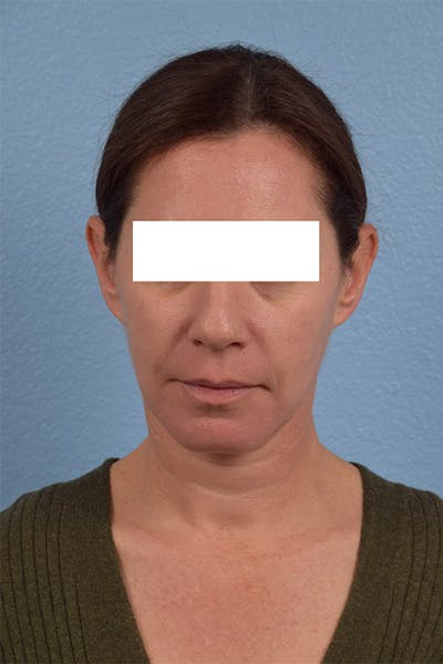 Hidden Patients Before & After Gallery - Patient 997193 - Image 1