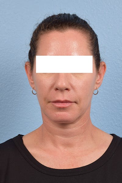 Hidden Patients Before & After Gallery - Patient 997193 - Image 2