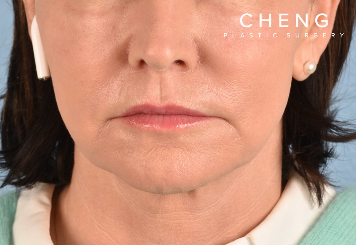 Hidden Patients Before & After Gallery - Patient 262095 - Image 2