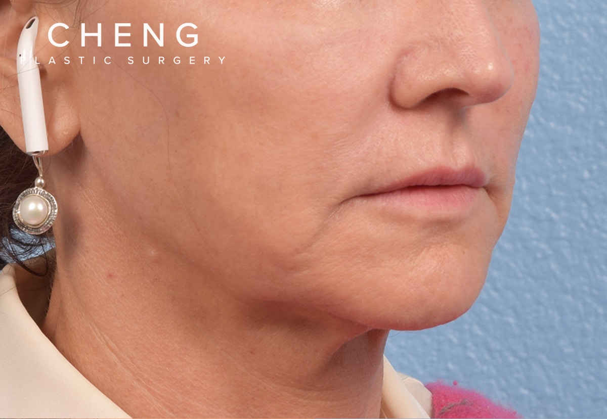 Hidden Patients Before & After Gallery - Patient 262095 - Image 9