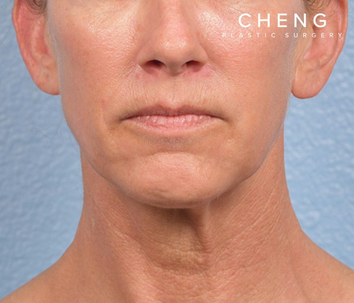 Hidden Patients Before & After Gallery - Patient 308206 - Image 2