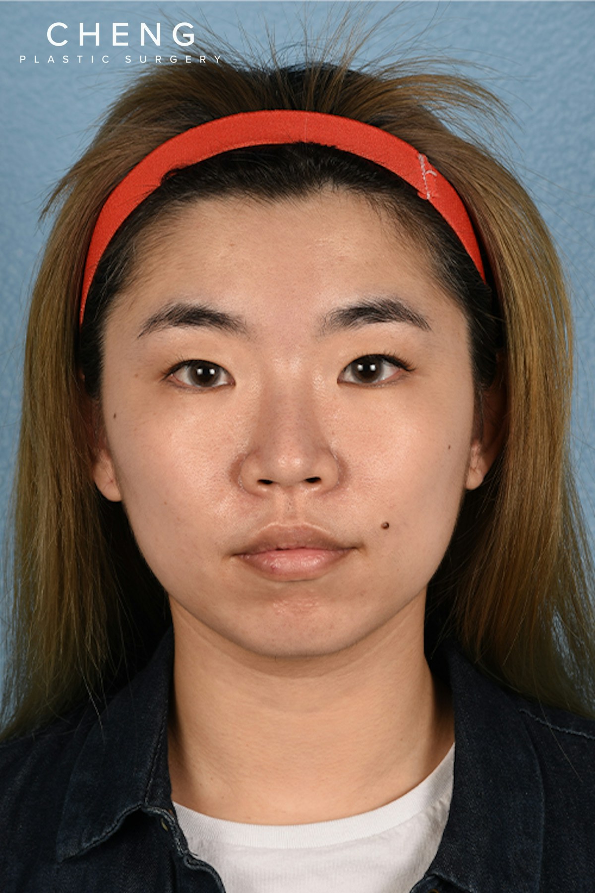 Thermage FLX  Before & After Gallery - Patient 614479 - Image 1