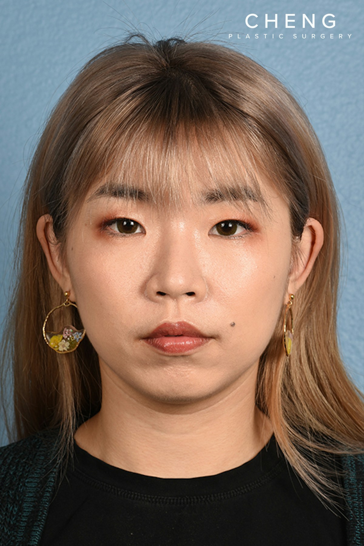 Thermage FLX  Before & After Gallery - Patient 614479 - Image 2