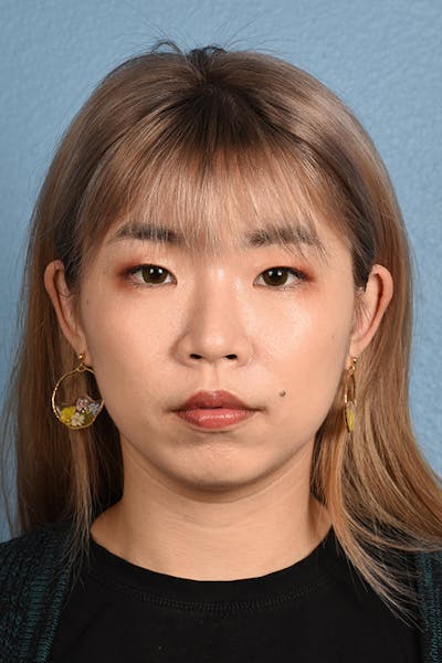 Thermage FLX  Before & After Gallery - Patient 614479 - Image 2