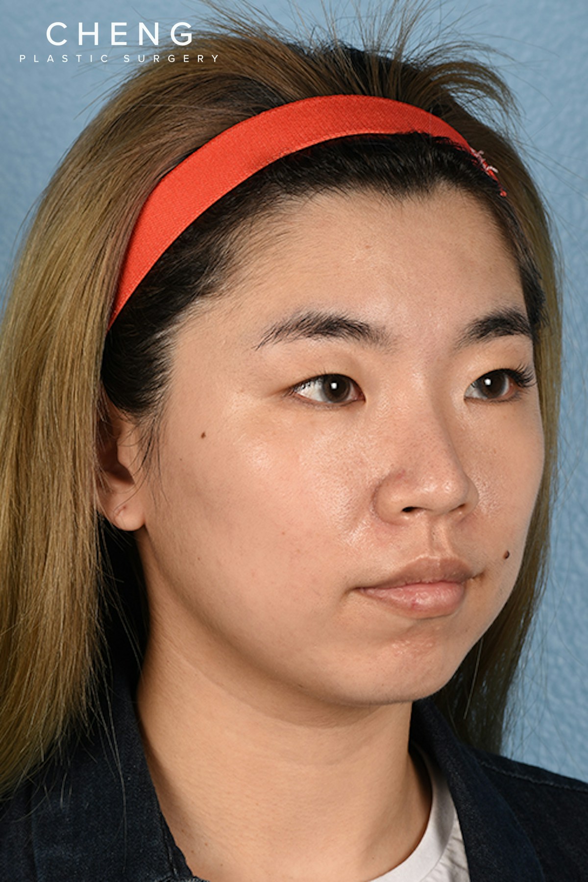 Thermage FLX  Before & After Gallery - Patient 614479 - Image 3