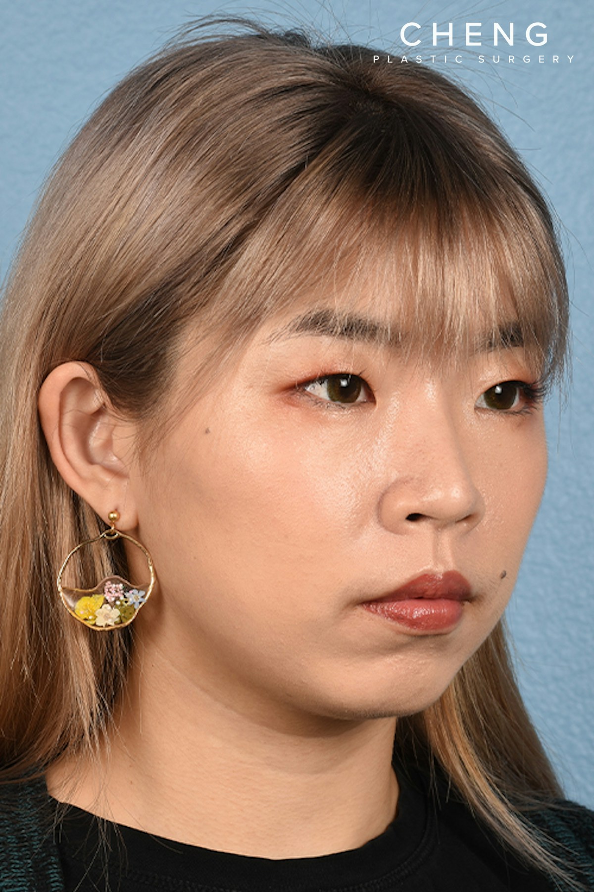 Thermage FLX  Before & After Gallery - Patient 614479 - Image 4