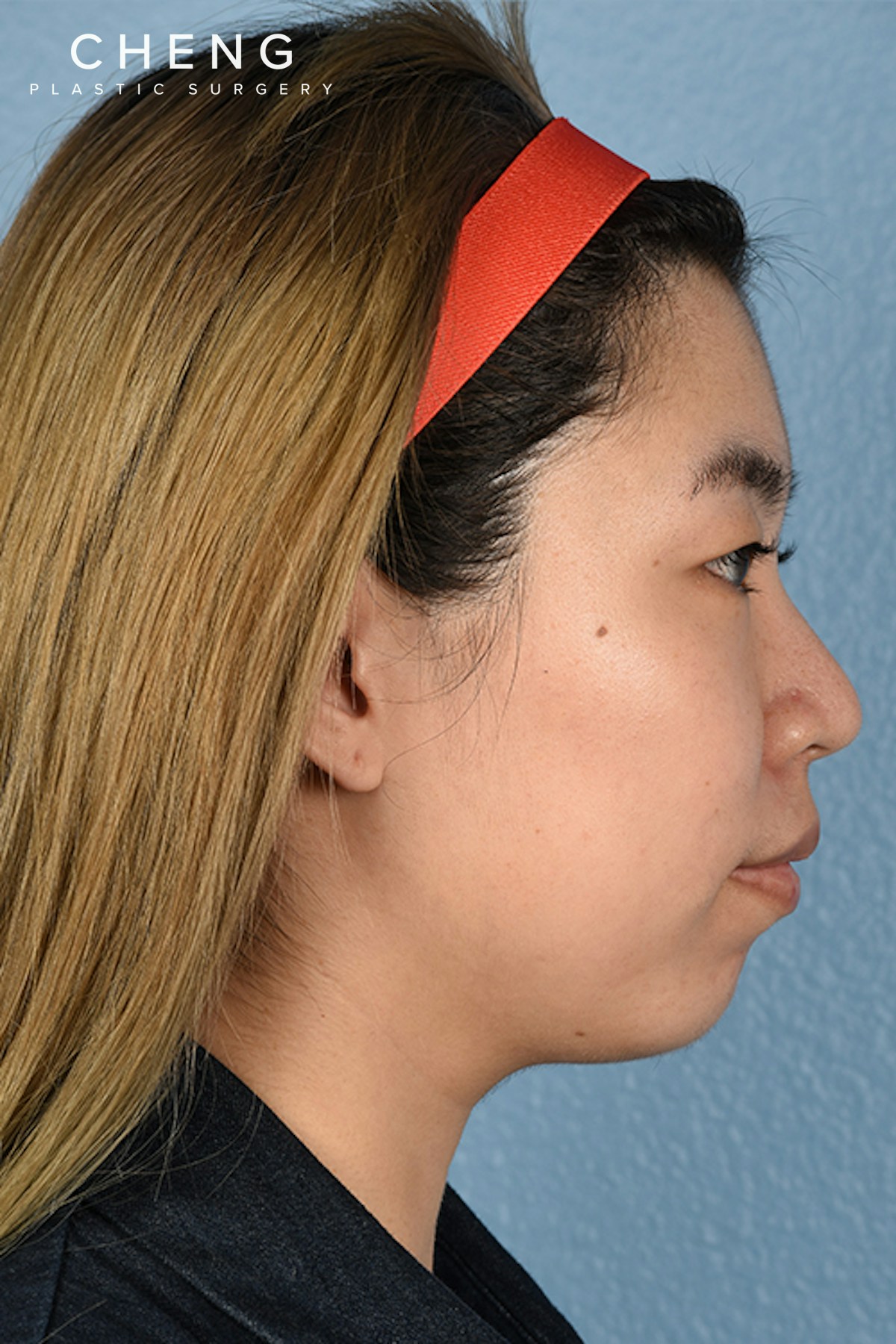 Thermage FLX  Before & After Gallery - Patient 614479 - Image 5