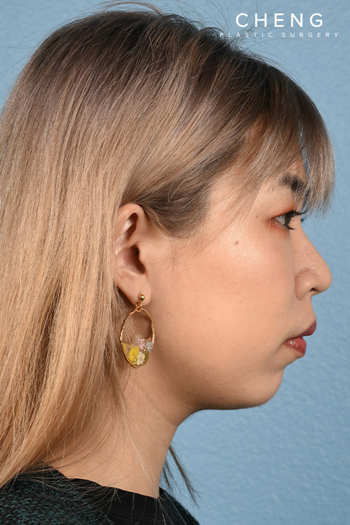 Thermage FLX  Before & After Gallery - Patient 614479 - Image 6