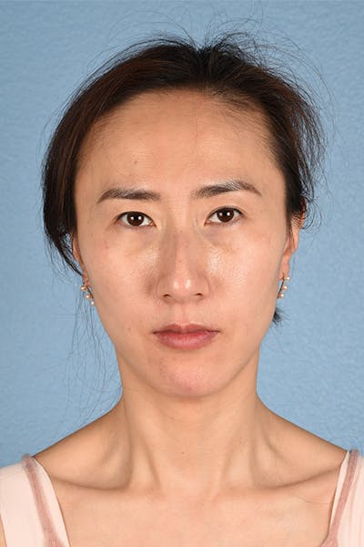 Hidden Patients Before & After Gallery - Patient 128909 - Image 2