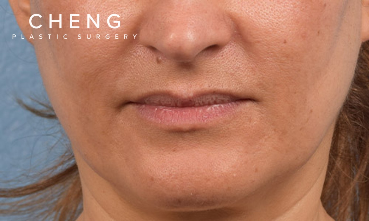Hidden Patients Before & After Gallery - Patient 358781 - Image 1