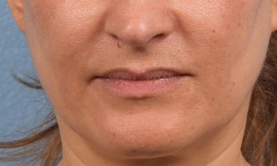 Hidden Patients Before & After Gallery - Patient 358781 - Image 1