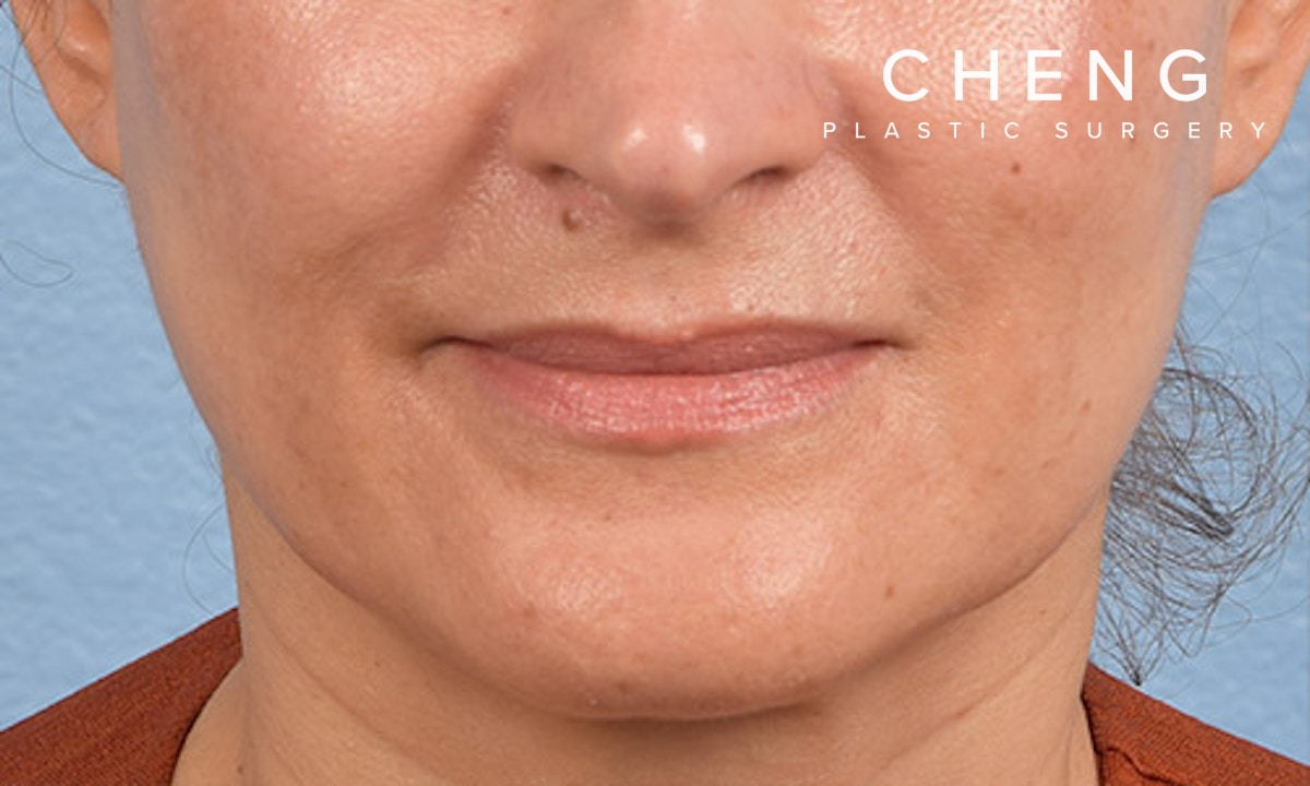 Hidden Patients Before & After Gallery - Patient 358781 - Image 2