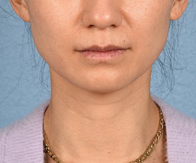 Hidden Patients Before & After Gallery - Patient 343443 - Image 1
