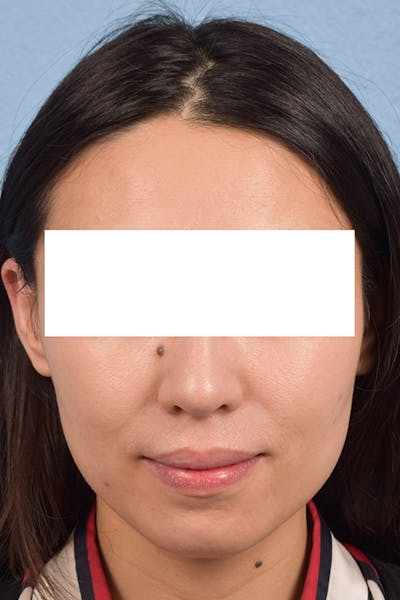 Hidden Patients Before & After Gallery - Patient 209797 - Image 2