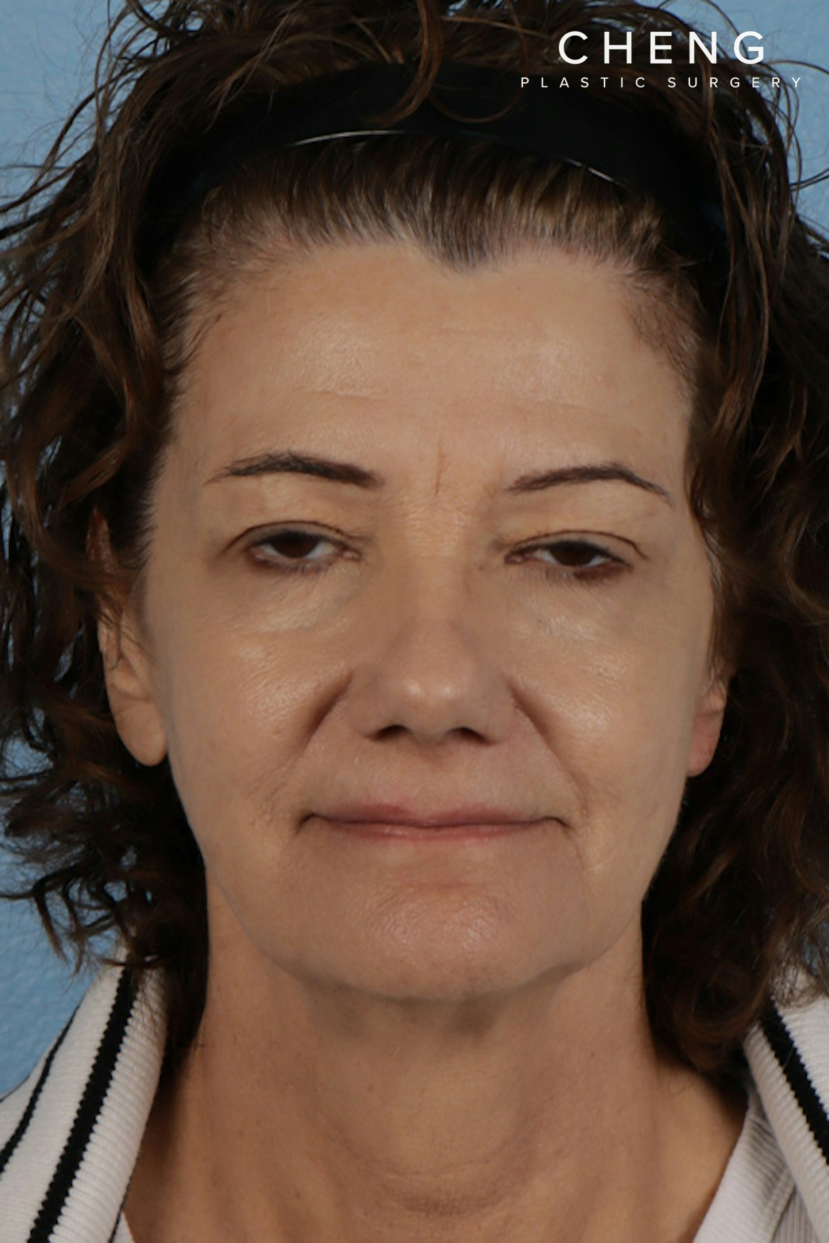 Pigment Laser Before & After Gallery - Patient 374844 - Image 2
